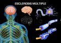 esclerosis-multiple