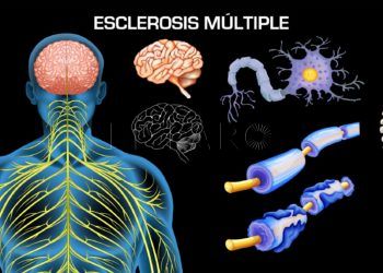 esclerosis-multiple