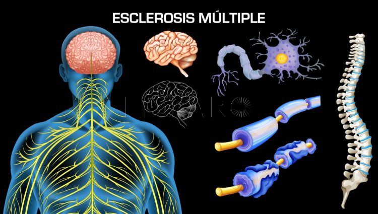 esclerosis-multiple