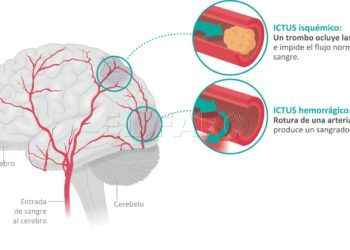 ictus