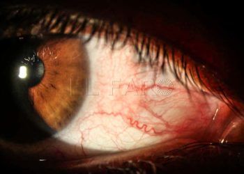 ojo
