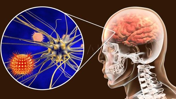 meningitis