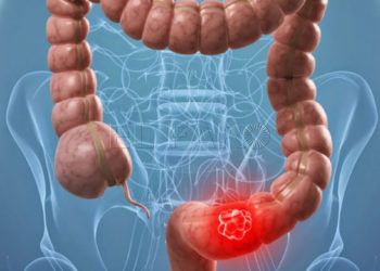 cáncer-colorrectal
