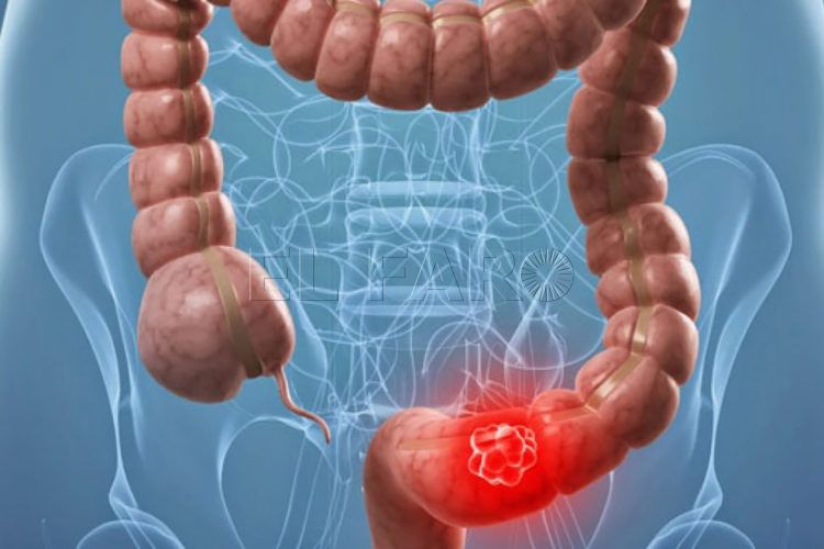 cáncer-colorrectal