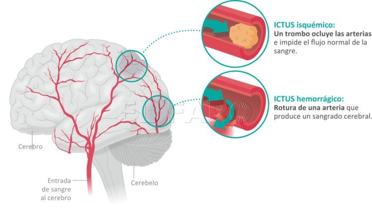 ictus