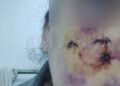 brutal-ataque-malinois-destrozo-cara-mujer